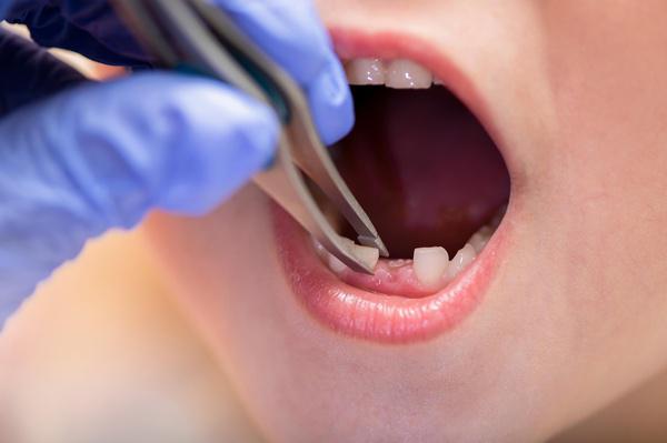 Pediatric Tooth Extraction Kensington, MD