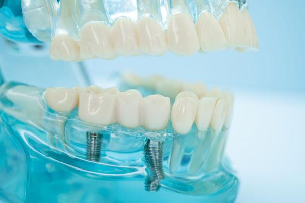 Dental Implants Silver Spring, MD