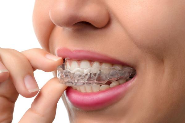 Invisalign Silver Spring, MD